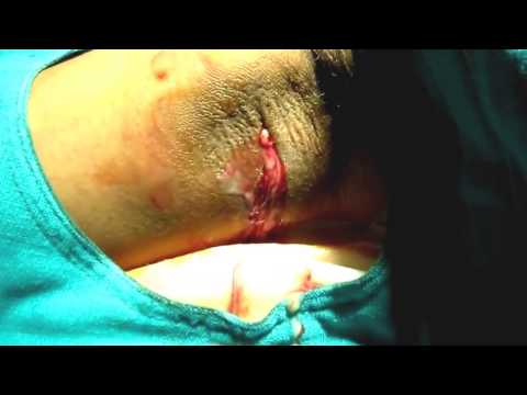 how to drain axillary abscess