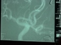 Endovascular Coiling of Ruptured 3.5 mm Anterior Communicating Arterial Aneurysm