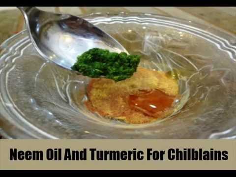 how to cure chilblains