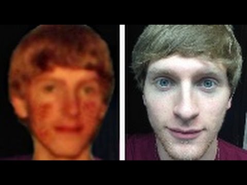 How I treated acne fast ( 3 days )