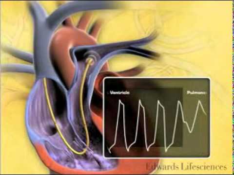 how to measure pulmonary artery pressure