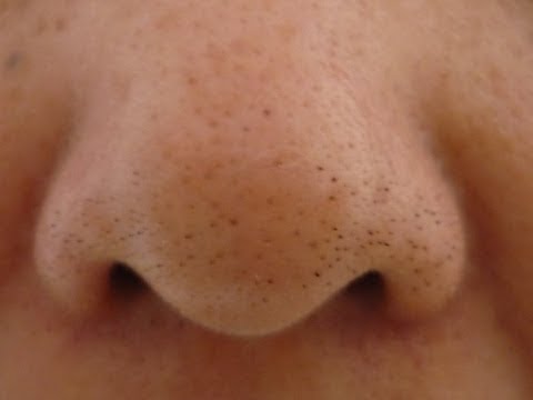 how to get rid of t zone acne