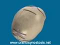 Treatment of  Sagittal Synostosis - Craniosynostosis Surgery