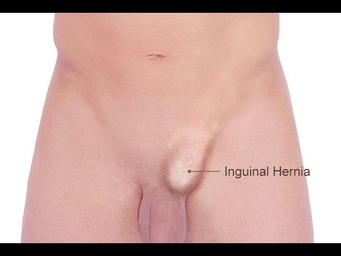 how to exam for inguinal hernia