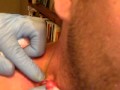 Infected Sebaceous Cyst drained.