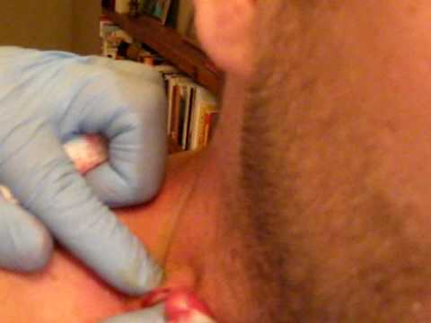 how to drain epidermal cyst