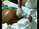 extraccion deliquido abdominal por cirrosis hepatica