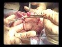 Osada Procedure for Massive Adenomyosis: Preserving Uterus
