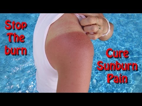how to cure sunburn