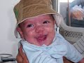 Cleft Lip & Palate Before & After 