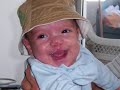 Cleft Lip & Palate Before & After 