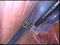 Laparoscopic Cholecystectomy Procedure Laparoscopic Cholecystectomy Procedure