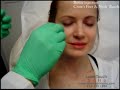Botox Crow's feet & Neck Bands