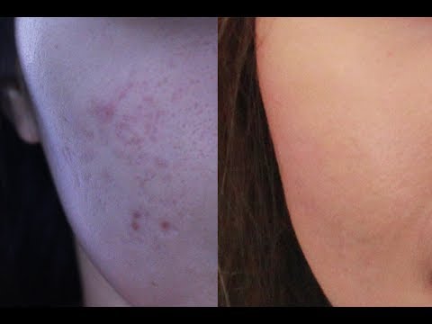 how to hide acne scars