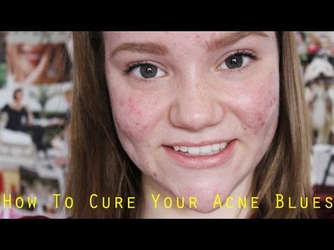 how to deal with acne