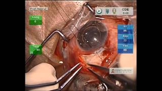 Repair and scleral patch graft in exposed AGV tube 