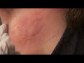 Draining armpit cyst