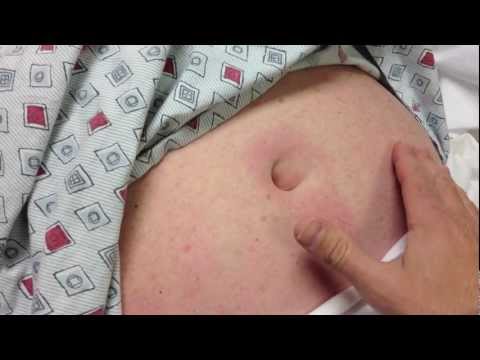 how to relieve umbilical hernia pain