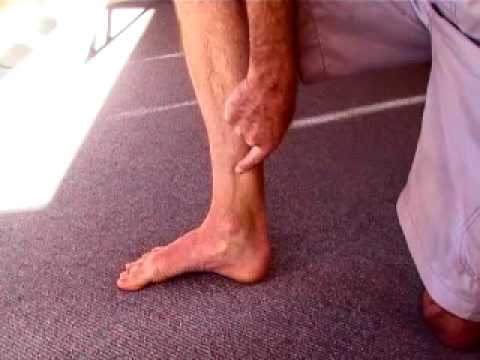 how to cure shin splints