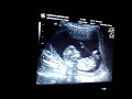 Ultrasonido Valentina