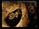 20081204 Ecografia.avi