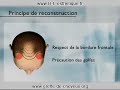 La greffe de cheveux (Microtransplantation folicullaire) La greffe de cheveux (Microtransplantation folicullaire)