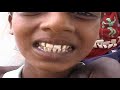 Fluorosis A Man Made Crisis Fluorosis A Man Made Crisis
