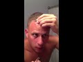 At Home Cyst Removal