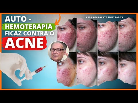 Auto-Hemoterapia Em Casos De Acne