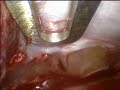 Endoscopic Brow Lift