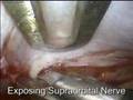 Endoscopic Brow Lift