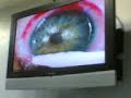 Intervencion tecnica Lasik