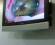 Intervencion tecnica Lasik