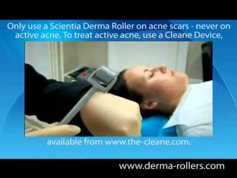 how to treat ice pick scars at home