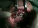Bioparts - Cirurgia da Mandíbula na Espanha Bioparts - Cirurgia da Mandíbula na Espanha