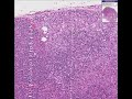Histopathology Lymph node-- Metastatic breast carcinoma
