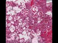 Histopathology Lung--Goodpasture syndrome, pulmonary hemorrh Histopathology Lung--Goodpasture syndrome, pulmonary hemorrh