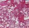 Histopathology Lung--Goodpasture syndrome, pulmonary hemorrh