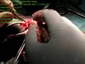 videos de arteriovenous fistula