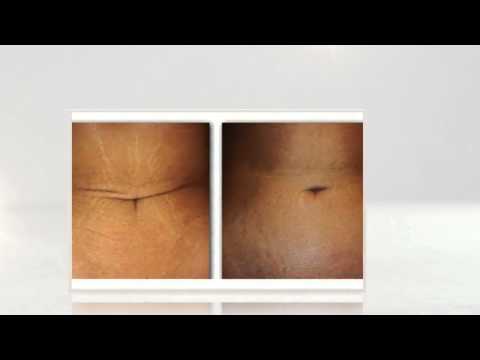 how to lose loose skin after c-section