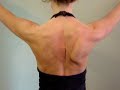 Damaged long thoracic - winging scapula Damaged long thoracic - winging scapula