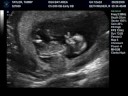 Taylor Twins - Baby A waving hands! Taylor Twins - Baby A waving hands!