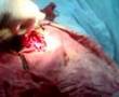 cesarean 2