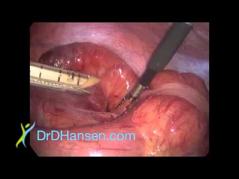 how to perform appendix surgery