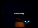 25 Gauge Vitrectomy Macular Hole