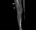 CT Knie