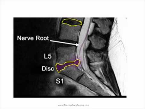 how to cure slip disc