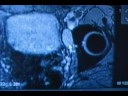 Prostate Cancer-New Found!