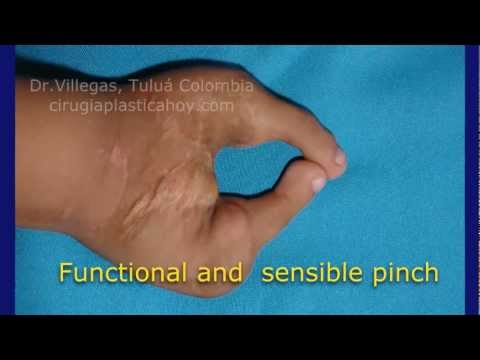 Residual Limb Wrapping