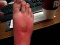 videos de Sunburn boo boo